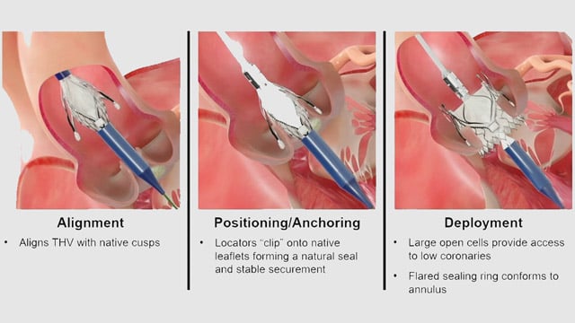 Emerging indications for TAVI in 2025