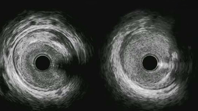 Evolving bifurcation treatment practices: drug-coated balloons, angio-based FFR, and side branch optimisation