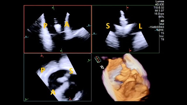 From innovation to integration: the evolution of 4D intracardiac echocardiography in structural heart interventions