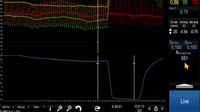 How a new generation of coronary sinus reducer can significantly expand treatment options for patients with coronary microvascular dysfunction