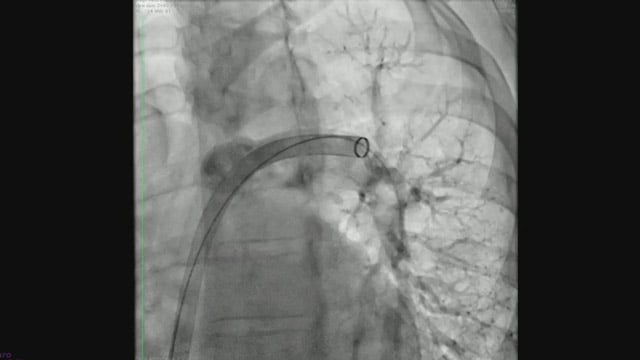 How are we going to treat these sick patients presenting with pulmonary embolism?
