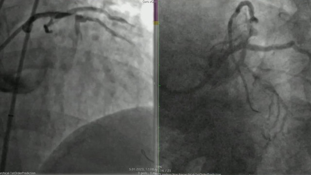 How to avoid and manage complications in CTO interventions