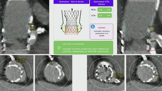 How to handle the most clinically relevant challenges in TAVI