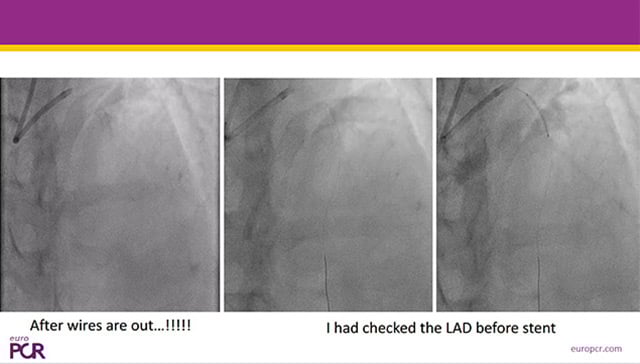 How to manage acute complications during bifurcation PCI