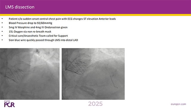 How to manage iatrogenic dissection of the left main trunk