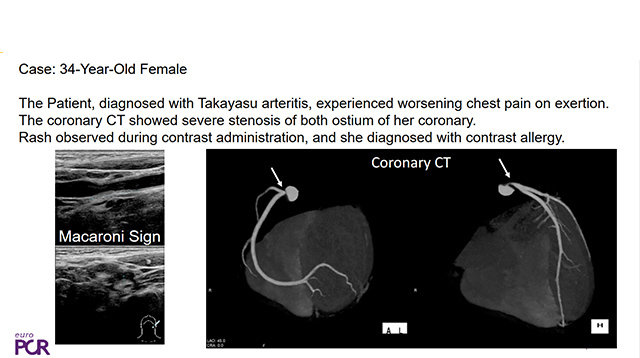 Iatrogenic causes for shock treated with LV support