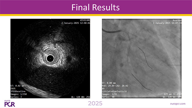 Imaging-based strategies for complication management in STEMI