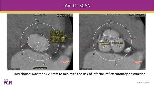 Imaging skills for successful TAVI procedure
