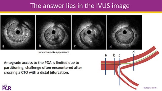Impact of imaging in treatment of bifurcation lesions - Part 1
