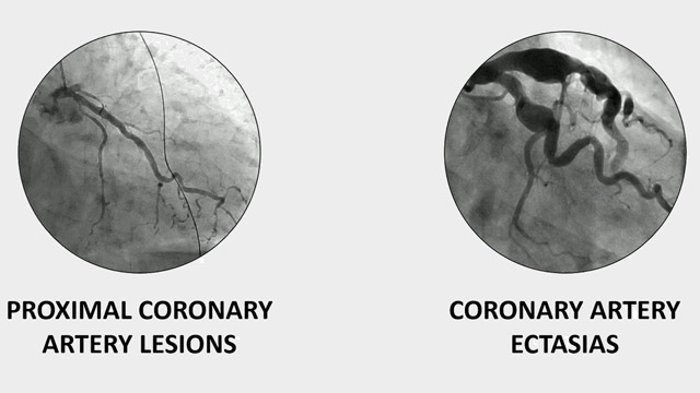 Innovative approaches to thrombus removal: redefining acute thromboembolic management in ACS