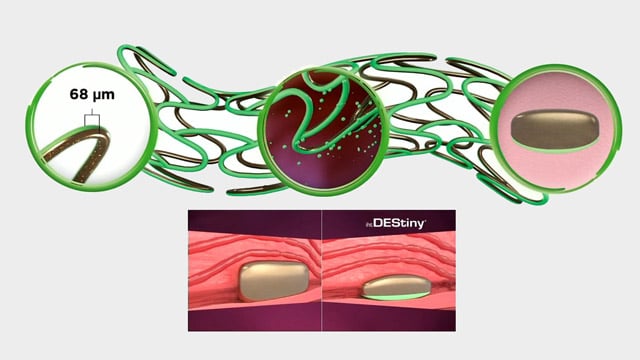 Innovative strategies for coronary interventions