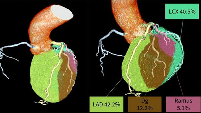 Integrating CT coronary angiography into your PCI practice