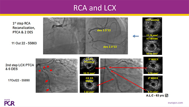 Intracoronary imaging for complex PCI: a must!