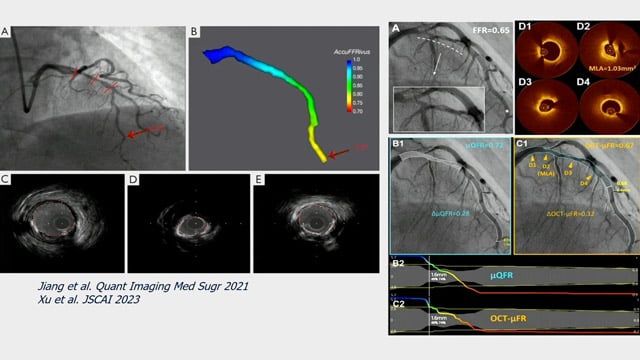 Intracoronary imaging guidance for PCI