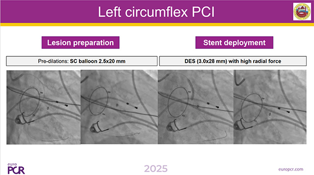 Intracoronary imaging real world clinical cases