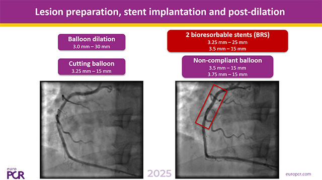Intracoronary value for PCI optimisation