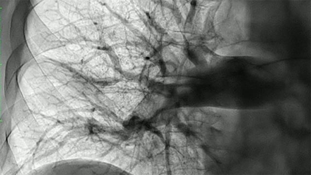 Key procedural factors in pulmonary embolism treatment with computer-assisted vacuum thrombectomy