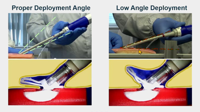 Successful finale - Latest best practices and technologies for large hole arterial and venous closure