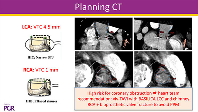 Leaflet modification to prevent coronary obstruction during TAVI