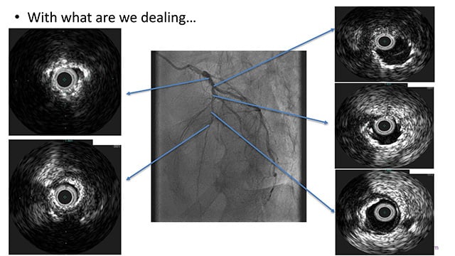 Left ventricle assist device for very high-risk PCI