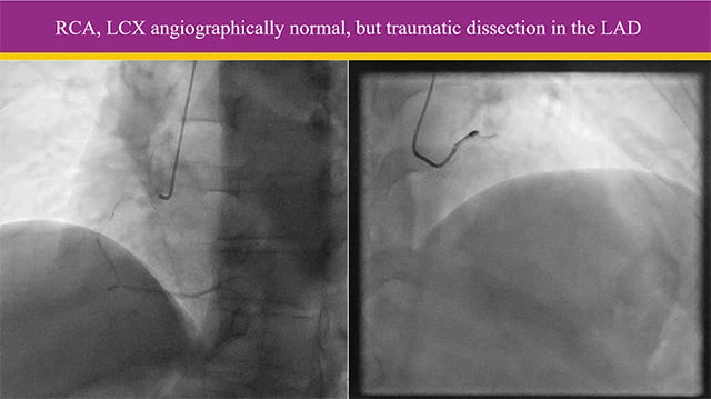 Management of bifurcations with complex anatomy - Part 1