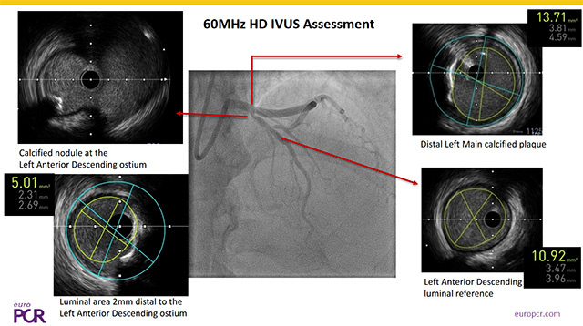 Management of heavy calcified bifurcation lesions