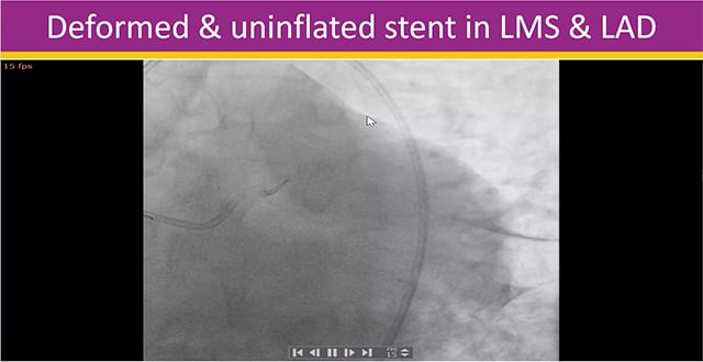 Management of stent-related complications