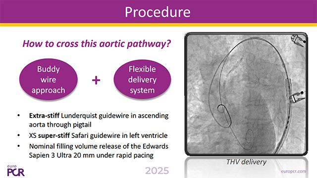 Managing challenging vasculature to successfully deliver TAVI