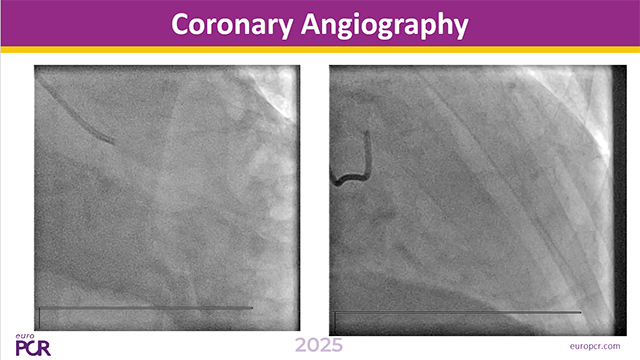 Managing difficult problems during TAVI procedures