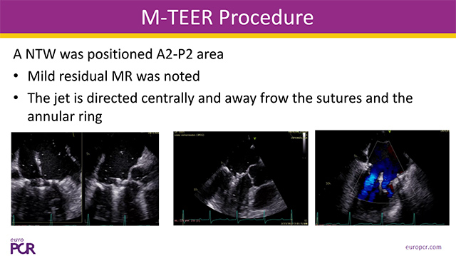 Mitral TEER in challenging scenarios - Part 2