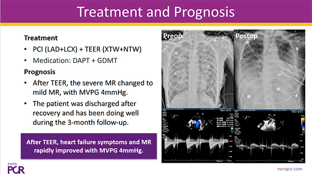 Mitral TEER in challenging scenarios - Part 3