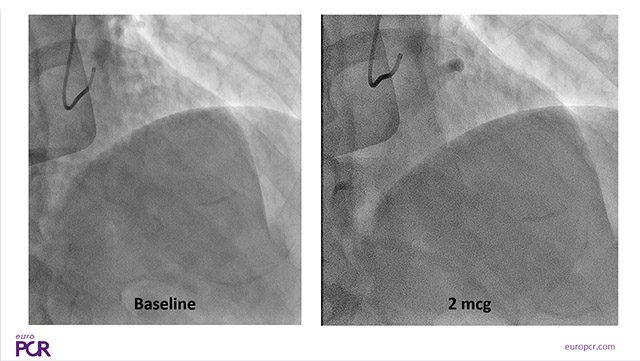 Multimodality imaging and physiology for MINOCA diagnosis