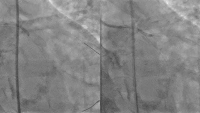 Navigating complexity in high-risk patients with multivessel disease undergoing PCI