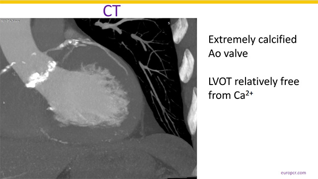 Navigating complexity: TAVI in challenging anatomies