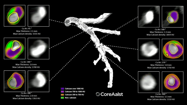 New perspectives in 3D calcium visualisation with CT and angiography for complex PCI