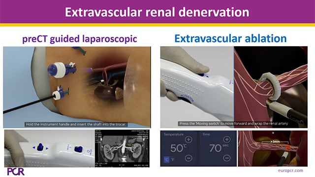 Novelties and future developments of sympathetic denervation to control blood pressure