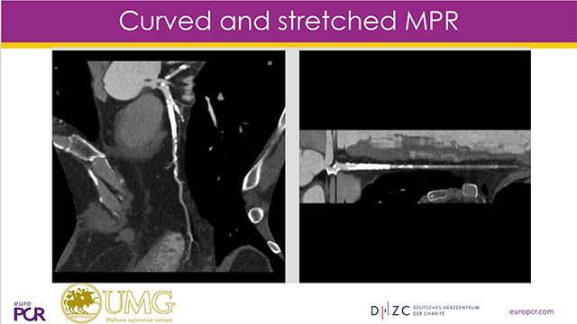 Optimising CTO outcomes by lesion selection