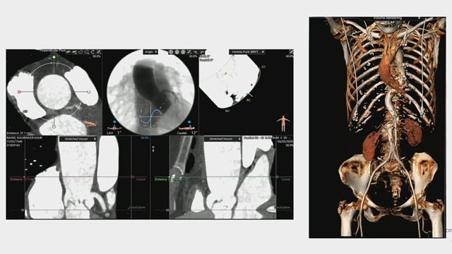Optimising self-expandable TAVI clinical outcomes without compromise