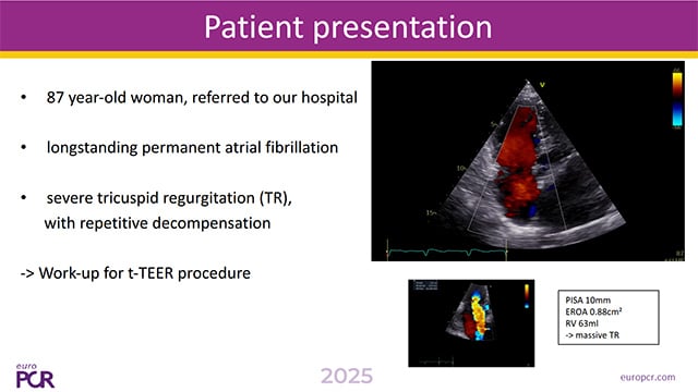 Optimising TEER in challenging anatomies