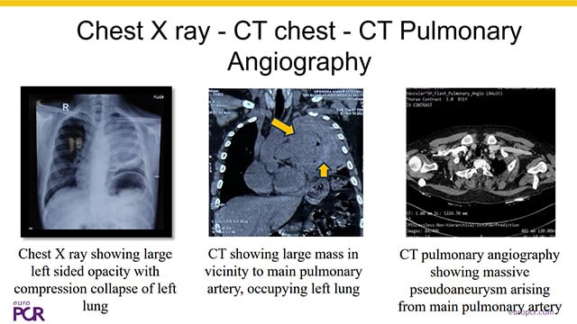Out of the box: tackling complex peripheral intervention