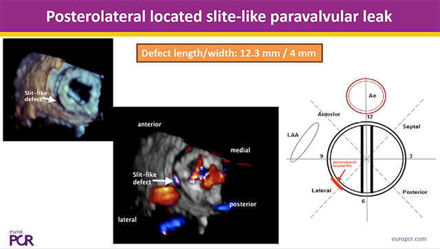 Paravalvular and defects percutaneous closure