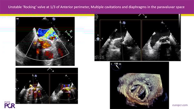 Paravalvular leak closure in TMVR