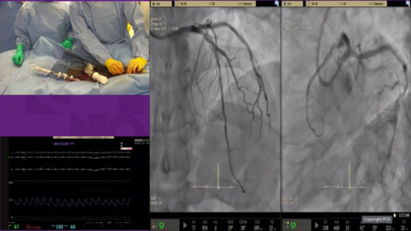 PCI for complex bifurcation disease - LIVE Case