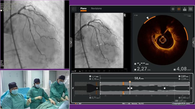 PCI for complex calcific coronary artery disease - LIVE Case