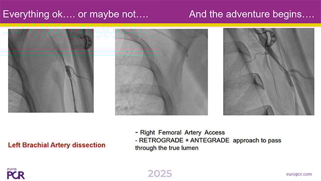 Peripheral interventions: the hidden key for complications