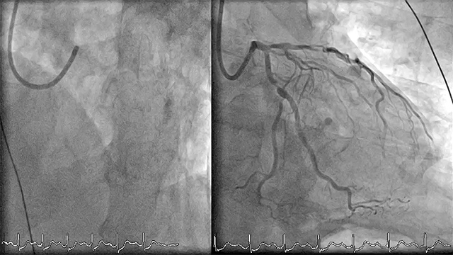 Primary PCI for STEMI – Optimising outcomes
