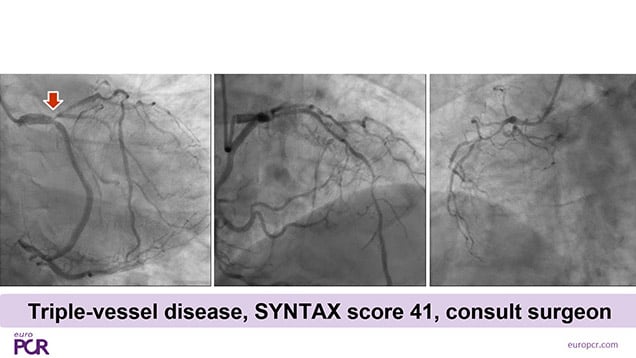 Primary PCI outside of the box: unusual STEMI cases