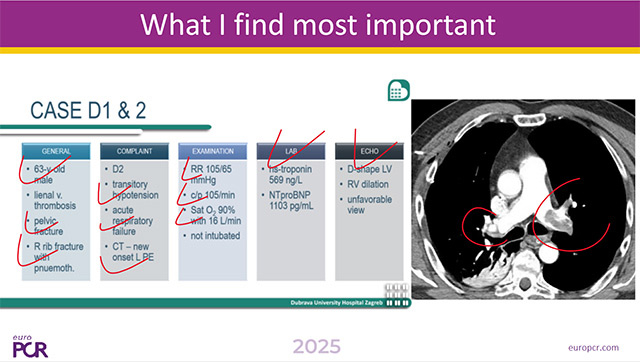 Pulmonary embolism - What should we do in the cathlab?