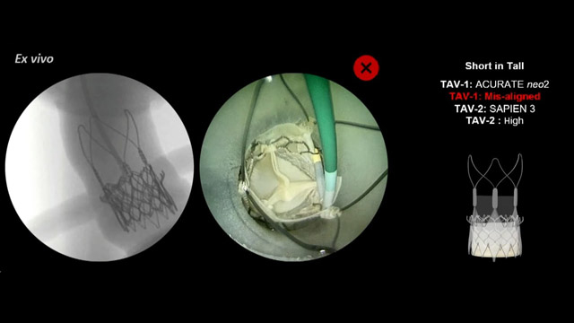 Redo TAVI - How to treat different TAVI platforms when they fail