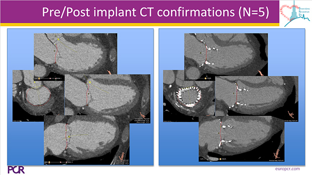 Right heart catheterisation and CT scan for the assessment of A-V valve treated percutaneously